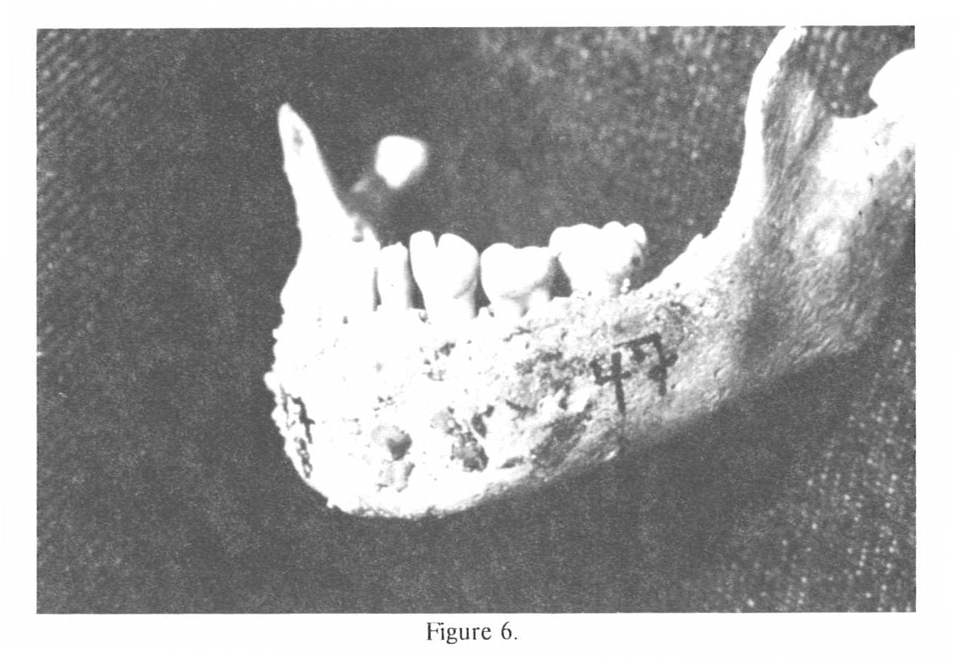 Set of Teeth - Two Teeth Fused