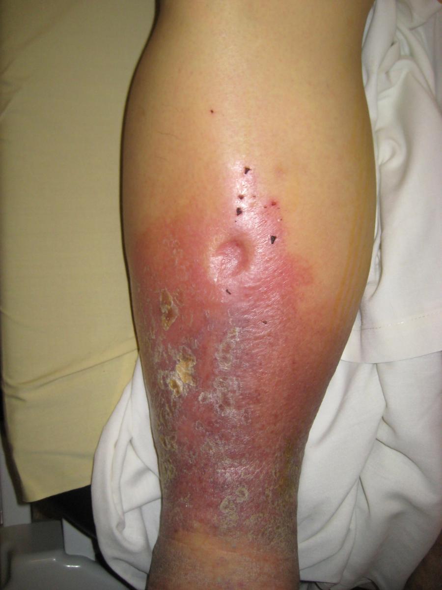 Edema in the leg