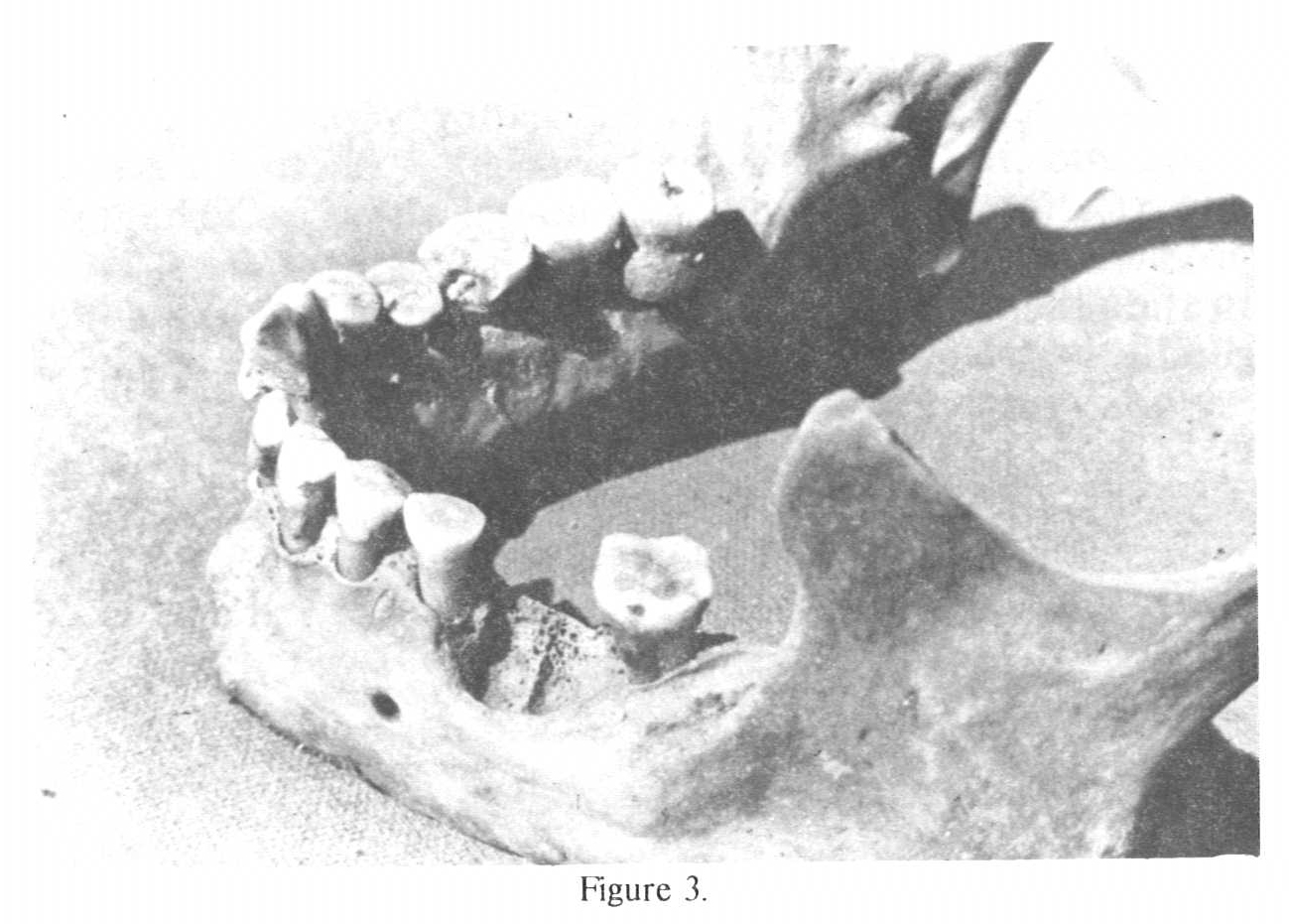 Set of Teeth with Missing Tooth