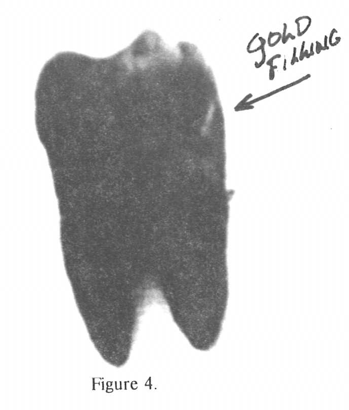 Tooth with Gold Filling