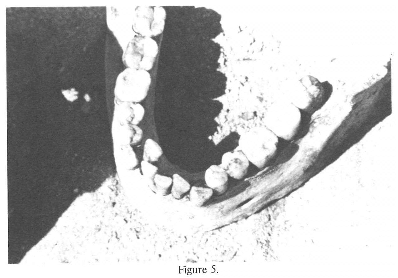 Set of Teeth with Wear